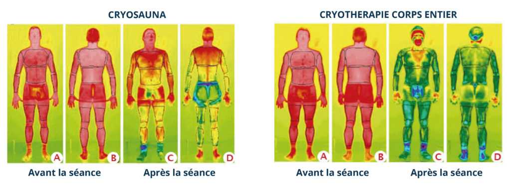 cryosauna vs cryotherapie corps entier